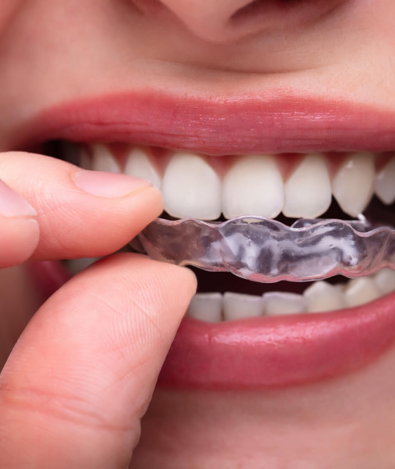 ventilatie Ambient vijver invisalign | Dental Clinic Bogaert